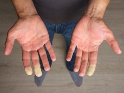 Man showing hands with Raynaud syndrome, Raynaud's phenomenon or Raynaud's disease. High quality photo
