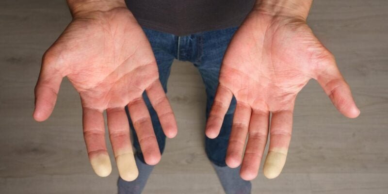 Man showing hands with Raynaud syndrome, Raynaud's phenomenon or Raynaud's disease. High quality photo